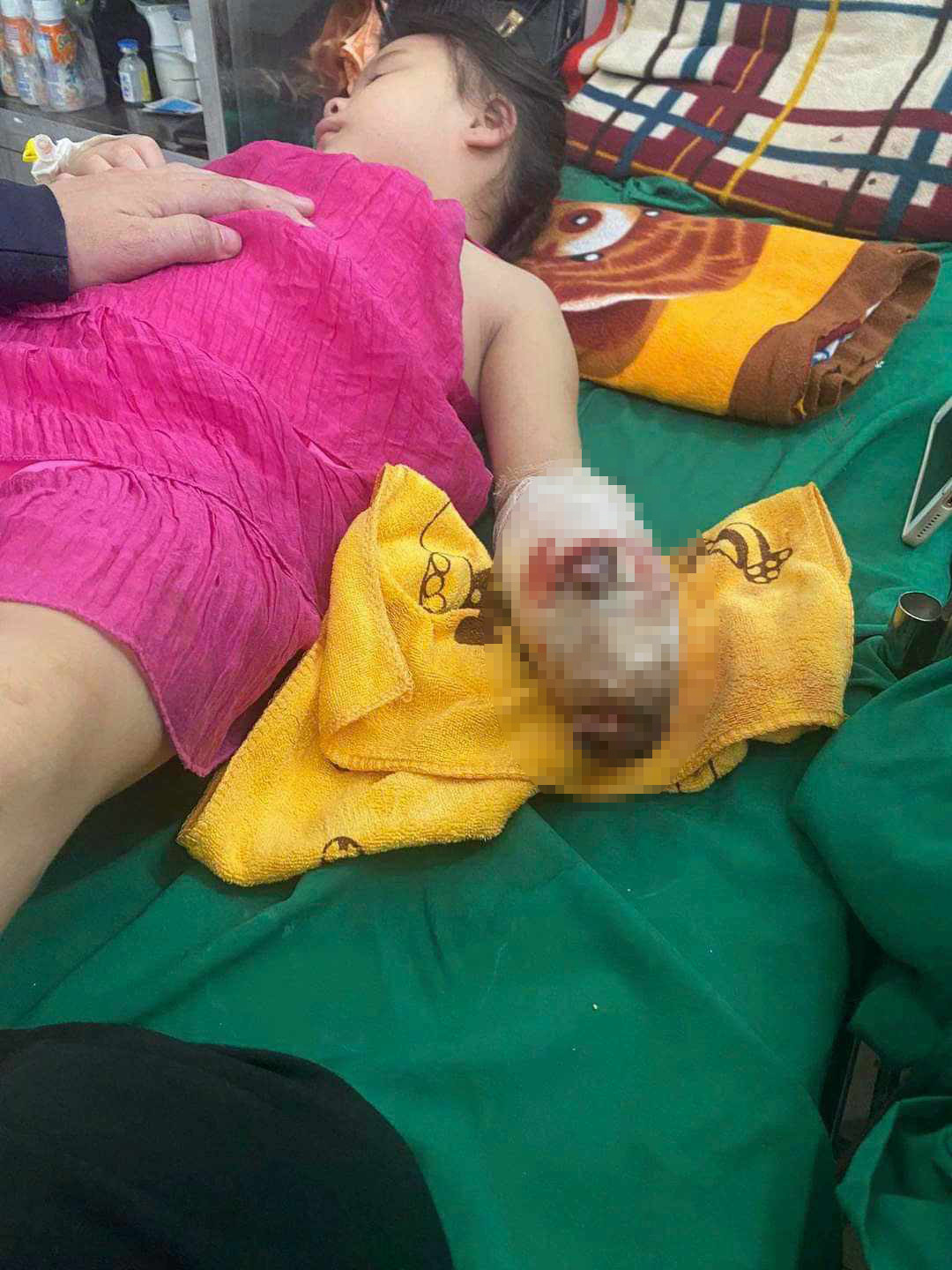 Cháu bé bị nát bàn tay trái.