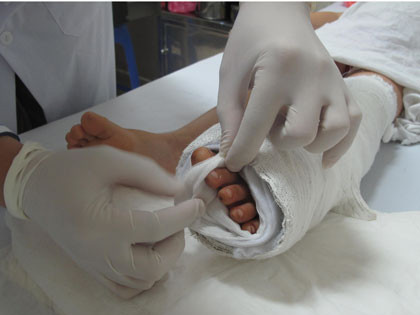 Sau 11 ngày được nối, 4 ngón chân đã hồng, ấm, có dấu hiệu sống