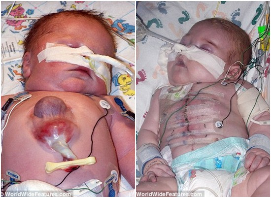 Ryan trước và sau khi phẫu thuật tim. Ryan trước và sau khi phẫu thuật tim