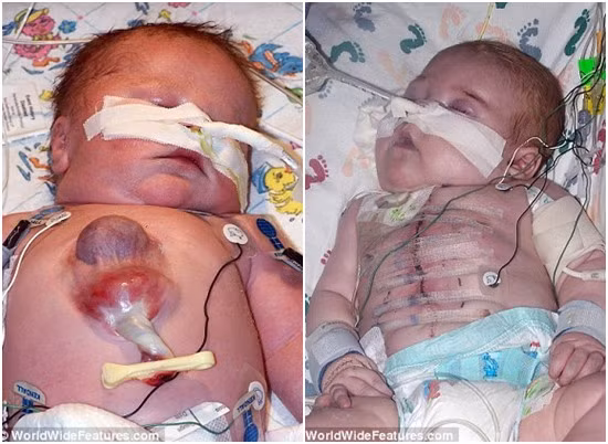 Ryan trước và sau khi phẫu thuật tim