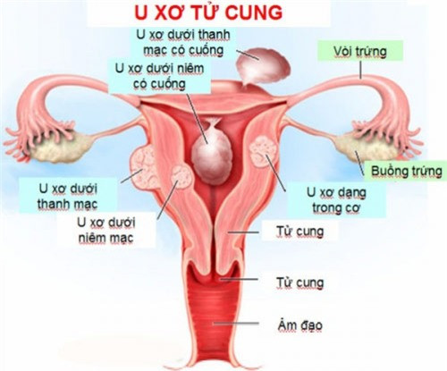 Đau bụng dưới, dấu hiệu ‘tố’ bạn mắc 1 trong 5 bệnh cực kỳ nguy hiểm ảnh 1