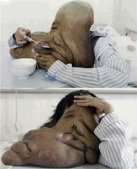 Người Voi của Trung Quốc, Huang Chuncai bị biến dạng khuôn mặt nghiêm trọng do hội chứng Neurofibromatosis. Khối u trên mặt anh nặng tới 20kg