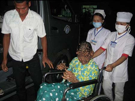 Cô Thạch Thị Sa Ly (35 tuổi, ngụ tỉnh Sóc Trăng) bị biến dạng thân hình từ đầu đến chân bởi toàn thân Sa Ly chi chít mụn thịt nhìn như … “da cá sấu”