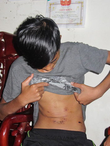 Vết thương còn hằn trên ngực. Vết thương còn hằn trên ngực