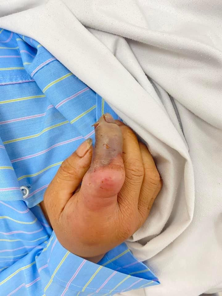 Bệnh nhân bị rắn hổ mang bành cắn đang điều trị tại BV Đa khoa tỉnh Hòa Bình. Ảnh; BS cung cấp Bệnh nhân bị rắn hổ mang bành cắn đang điều trị tại BV Đa khoa tỉnh Hòa Bình. Ảnh; BS cung cấp