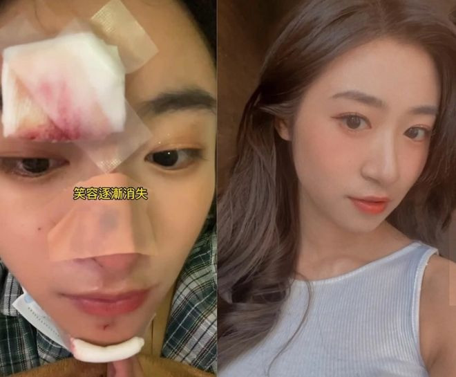 Gương mặt Hoàng Tử Ân bị tổn thương khi ngã đập mặt xuống đường. Ảnh: 163.