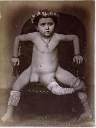 Blanche Dumas với cấu tạo cơ thể đặc biệt từ khi còn nhỏ.