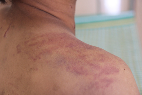 Các vết thương trên người cháu Tự do bị cha ruột đánh. Các vết thương trên người cháu Tự do bị cha ruột đánh