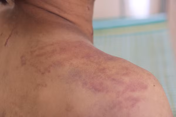  Các vết thương trên người cháu Tự do bị cha ruột đánh