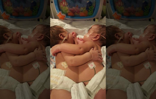 Mổ tách cặp song sinh gái dính liền tim ảnh 1