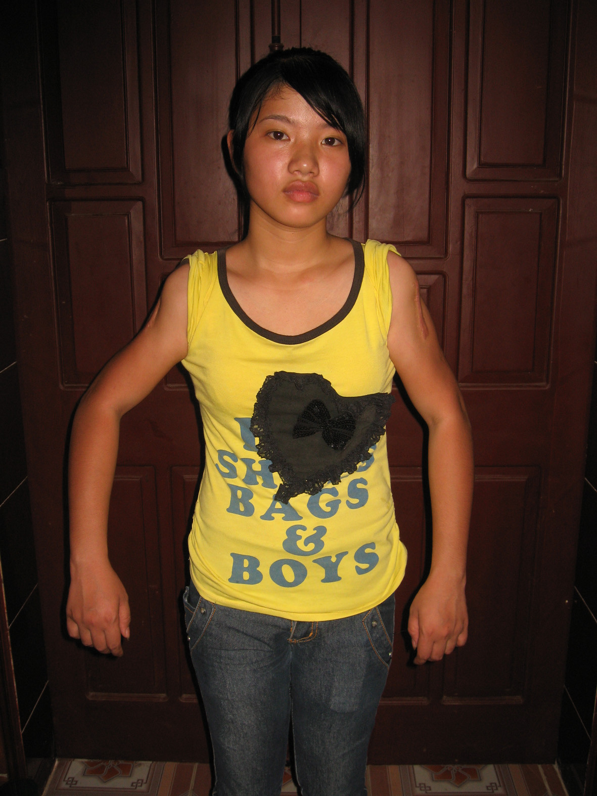 Nguyễn Thị Hằng với đôi tay vẫn khuỳnh khoàng sau 2 lần mổ