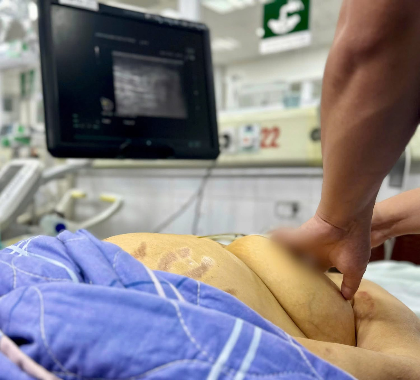 Khoảng 10 ngày trước khi nhập viện, bệnh nhân có vàng da tăng dần, bắt đầu mệt mỏi. Ảnh: Bệnh viện Bệnh Nhiệt đới Trung ương Khoảng 10 ngày trước khi nhập viện, bệnh nhân có vàng da tăng dần, bắt đầu mệt mỏi. Ảnh: Bệnh viện Bệnh Nhiệt đới Trung ương