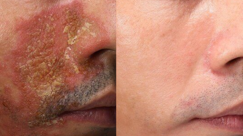 Hiệu quả điều trị vảy nến sau 20 ngày liệu trình Mezoplex tại DRH Clinic