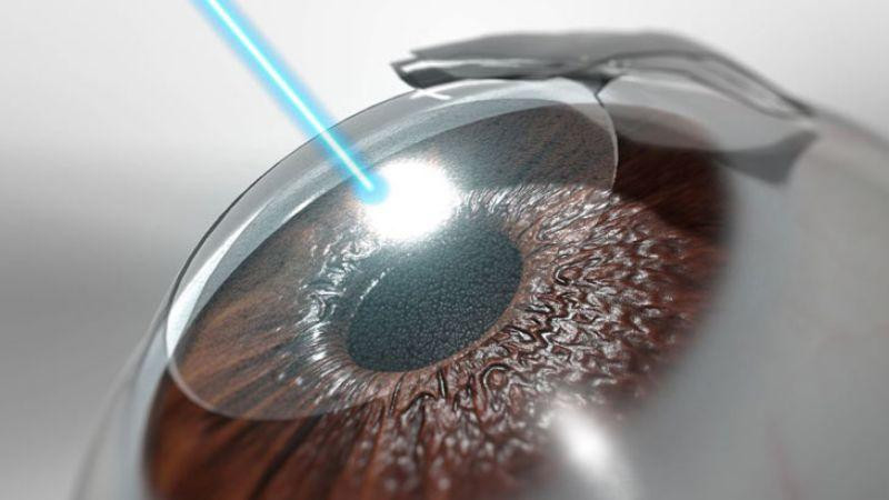 Phẫu thuật Lasik sử dụng laser để điều chỉnh độ cong của giác mạc Phẫu thuật Lasik sử dụng laser để điều chỉnh độ cong của giác mạc