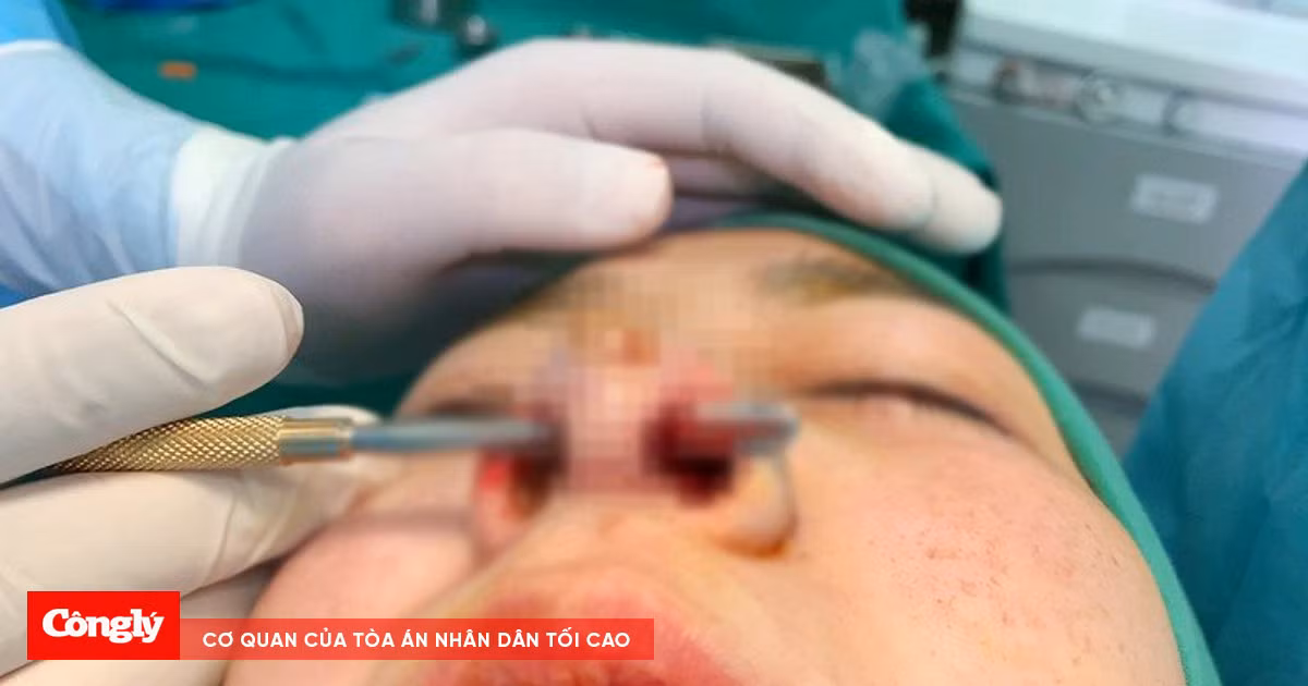Hàng loạt người kêu cứu vì biến chứng do nâng mũi cao Tây theo trào lưu