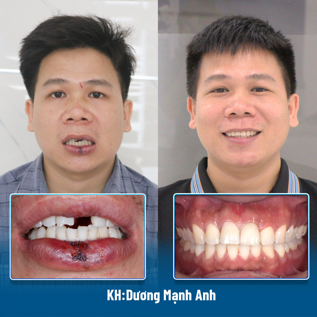 Khách hàng trồng răng implant bằng công nghệ DCT