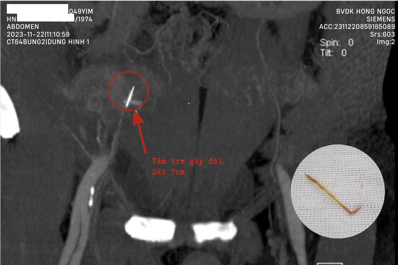 Dị vật đâm thủng ruột thừa, xác định sau mổ là đoạn tăm tre