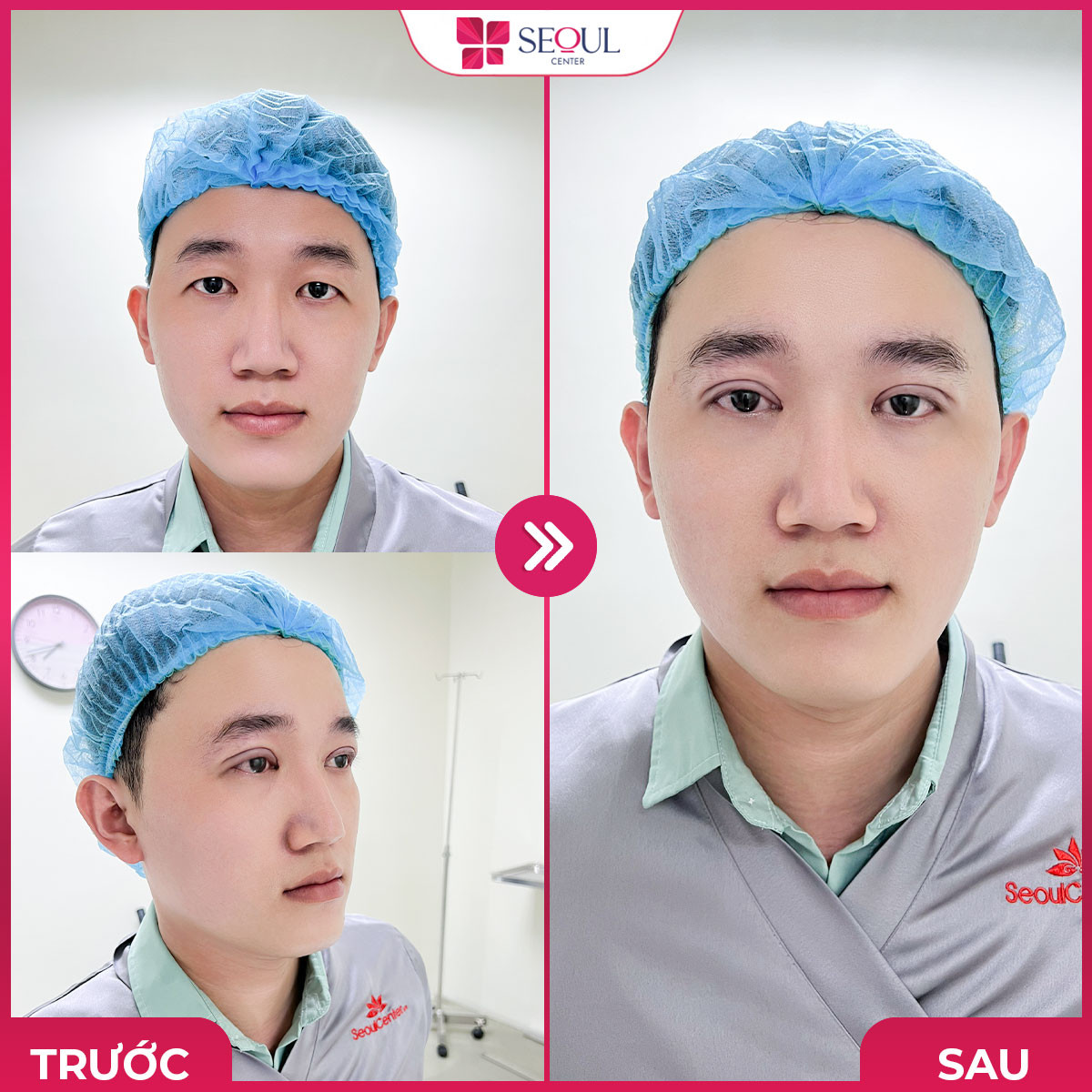 Kết quả nhấn mí mắt đẹp tự nhiên, ấn tượng.