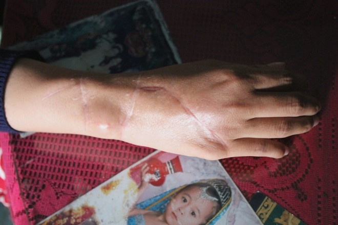 Các vết thương trên cánh tay chị Thúy 