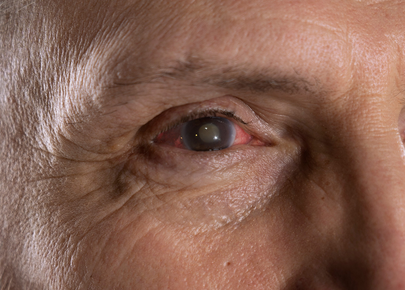 Glôcôm là bệnh lý tiến triển âm thầm với những biến chứng nguy hiểm ảnh hưởng đến thị lực