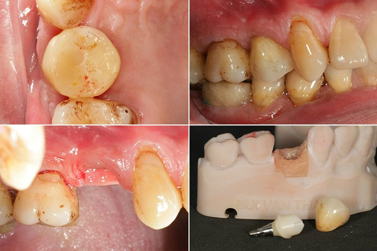 Abutment cá nhân hoá kết hợp răng sứ 3D Pro Multilayer giúp răng implant tiệm cận sự hoàn hảo