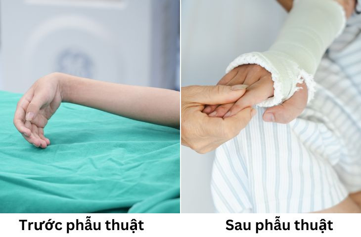 Trước phẫu thuật, cổ tay phải của Hùng luôn trong tình trạng gấp, không thể duỗi. Sau phẫu thuật, cổ tay của em đã có thể duỗi thẳng, ngón tay cử động linh hoạt.