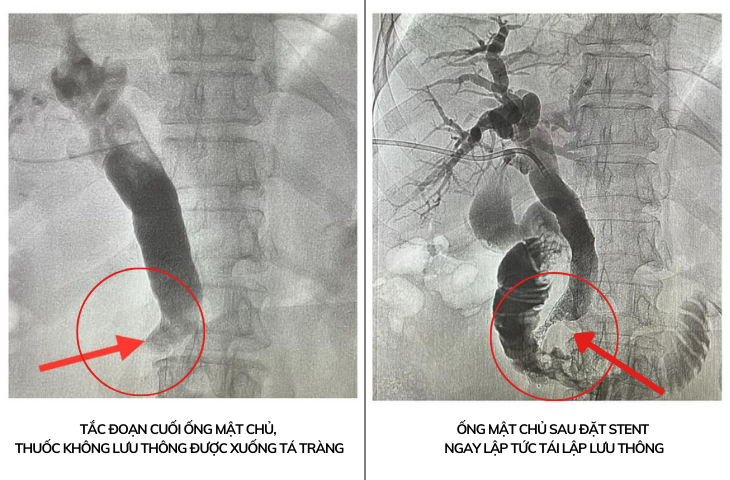 Ống mật chủ của bệnh nhân trước và sau khi được đặt stent