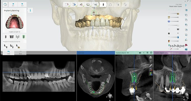 Lên kế hoạch điều trị an toàn bằng công nghệ giả lập 3D
