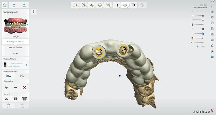 Cận cảnh quy trình thiết kế máng 3D Guide
