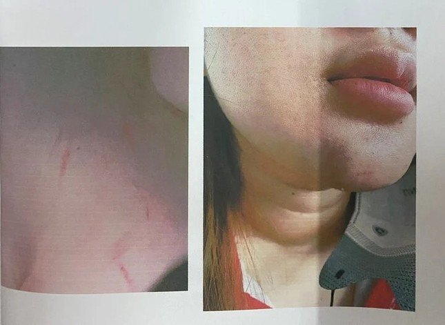 Nữ sinh T.H bị nhóm phụ huynh đánh hội đồng tại nơi sinh sống. Ảnh: B.L