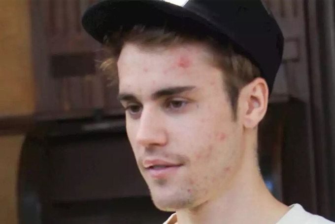 Justin Bieber mắc căn bệnh Lyme. Justin Bieber mắc căn bệnh Lyme.