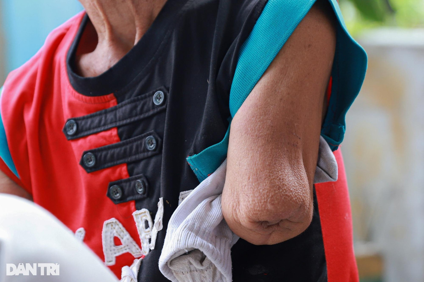 Ông Toàn mất đôi tay trong một lần vượt ngục (Ảnh: Quang Ninh).