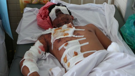 Ngoài cụt cánh tay, người em còn đối diện nguy cơ mù lòa do thuốc nổ.