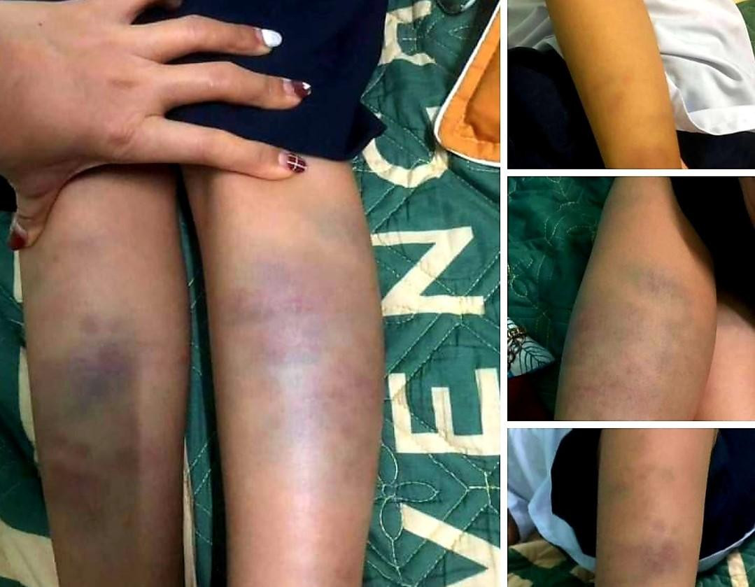 Bắp chân cháu H. sau khi từ trường về Bắp chân cháu H. sau khi từ trường về