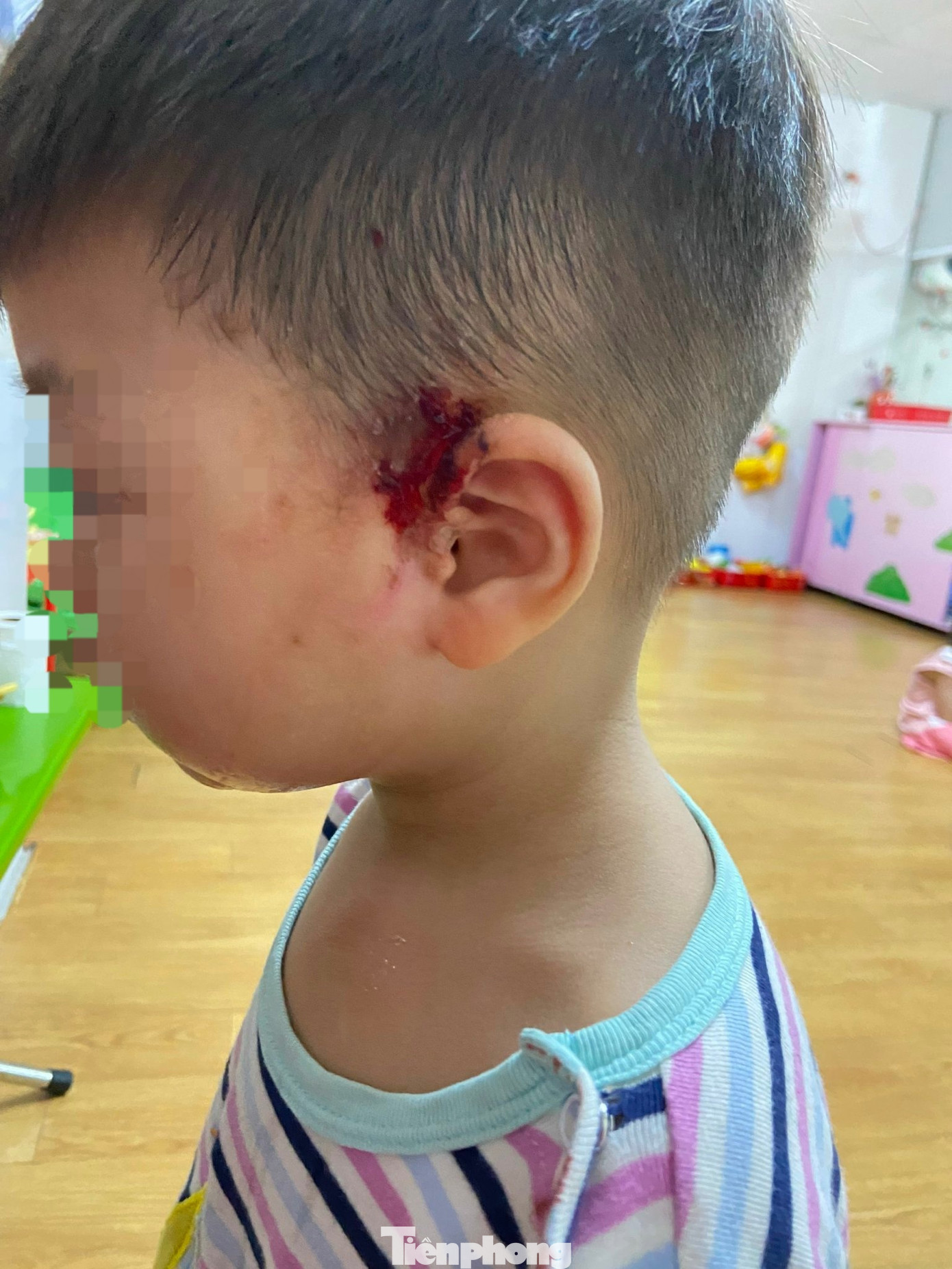 Cháu bé dính dịch kiến ba khoang làm lở loét cả vùng tai.