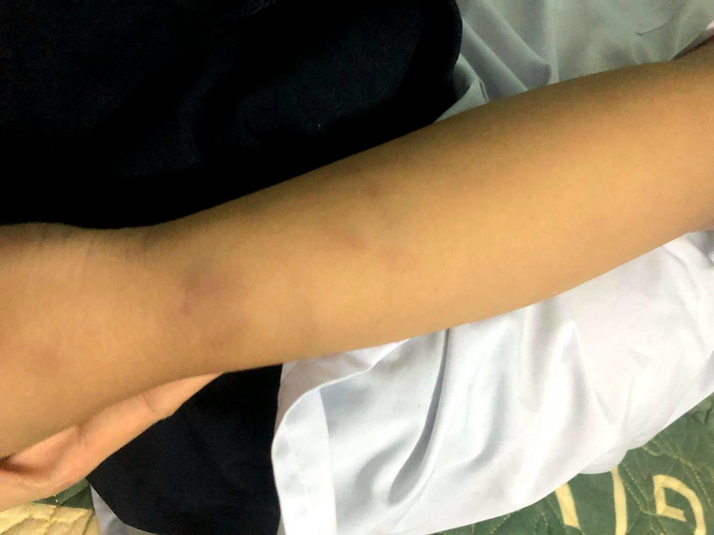 Tay cháu bé cũng có nhiều vết bầm.