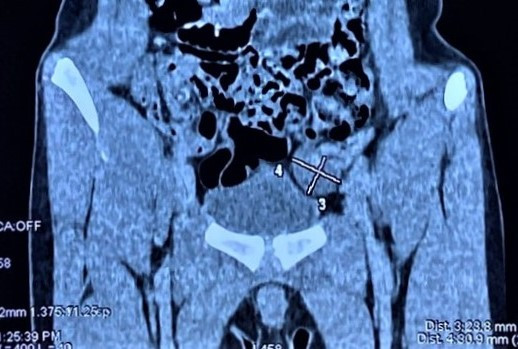 Tinh hoàn bé trai "chạy" lên ổ bụng.