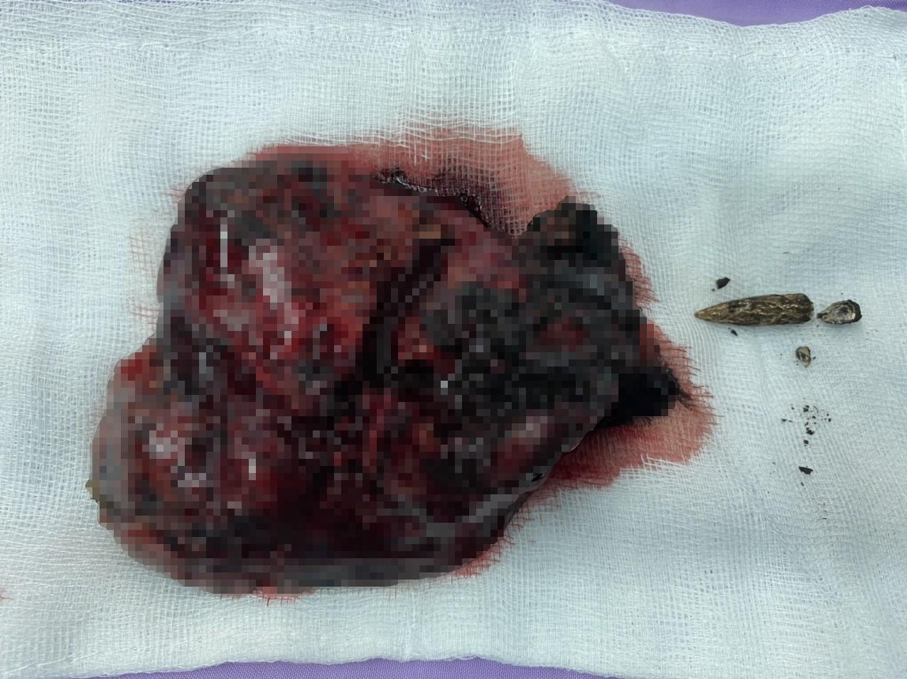 Đầu đạn nằm trong phổi cụ ông hơn 60 năm đã được lấy ra. Đầu đạn nằm trong phổi cụ ông hơn 60 năm đã được lấy ra.