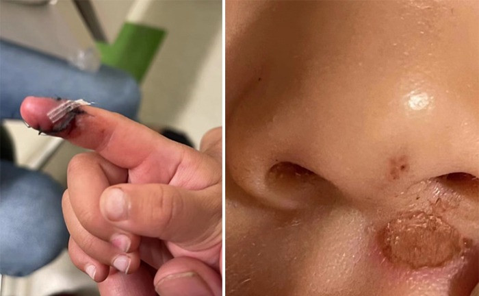 Trước đây, Trương Hằng công khai hình ảnh bị thương của hai con sau khi nhận hai đứa trẻ từ Trịnh Sảng. Anh hỏi nguyên nhân nhưng cô đưa ra nhiều lý do khác nhau. Ảnh: QQ. Trước đây, Trương Hằng công khai hình ảnh bị thương của hai con sau khi nhận hai đứa trẻ từ Trịnh Sảng. Anh hỏi nguyên nhân nhưng cô đưa ra nhiều lý do khác nhau. Ảnh: QQ.