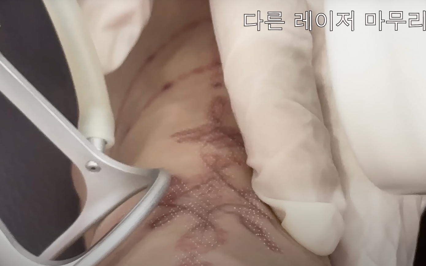 Nana đăng tải vlog đi xóa xăm. Ảnh: CMH. Nana đăng tải vlog đi xóa xăm. Ảnh: CMH.