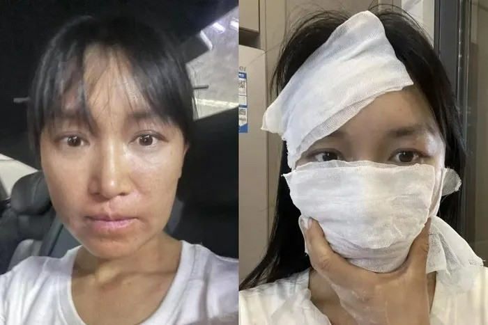 Lý Tử Thất bị dị ứng nặng khi làm đồ sơn mài năm 2023.