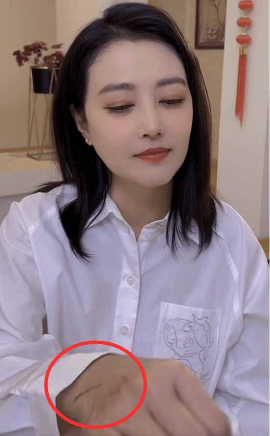 Cư dân mạng chỉ ra Châu Hải My nhiều lần lộ da mẩn đỏ như phát ban, vết sẹo và vết bầm tím trên tay. Ảnh: Sohu. Cư dân mạng chỉ ra Châu Hải My nhiều lần lộ da mẩn đỏ như phát ban, vết sẹo và vết bầm tím trên tay. Ảnh: Sohu.