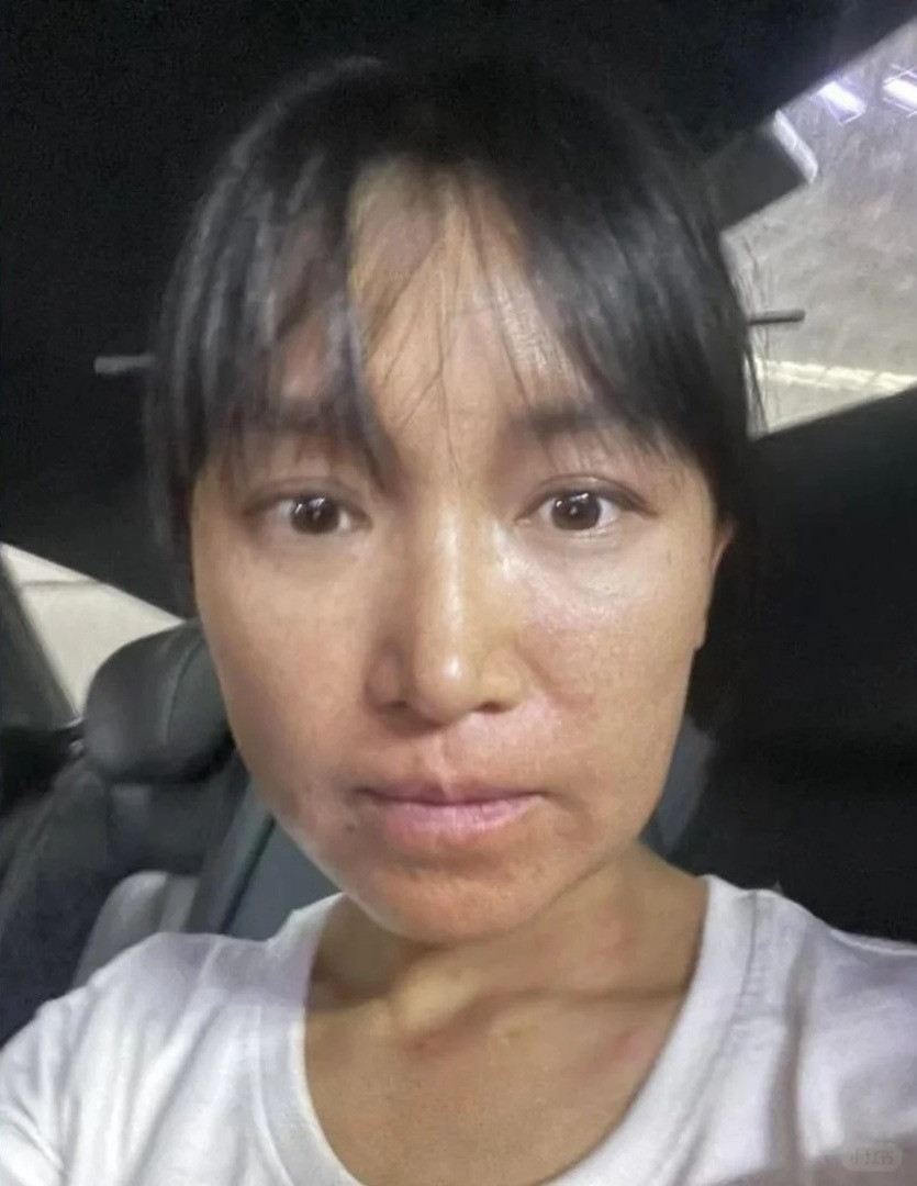 Lý Tử Thất bị dị ứng nặng khi làm tranh sơn mài (ảnh trái). Cô phải điều trị suốt năm 2023. Lý Tử Thất bị dị ứng nặng khi làm tranh sơn mài (ảnh trái). Cô phải điều trị suốt năm 2023.