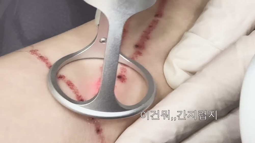 Nana đăng tải vlog đi xóa xăm. Ảnh: CMH. Nana đăng tải vlog đi xóa xăm. Ảnh: CMH.