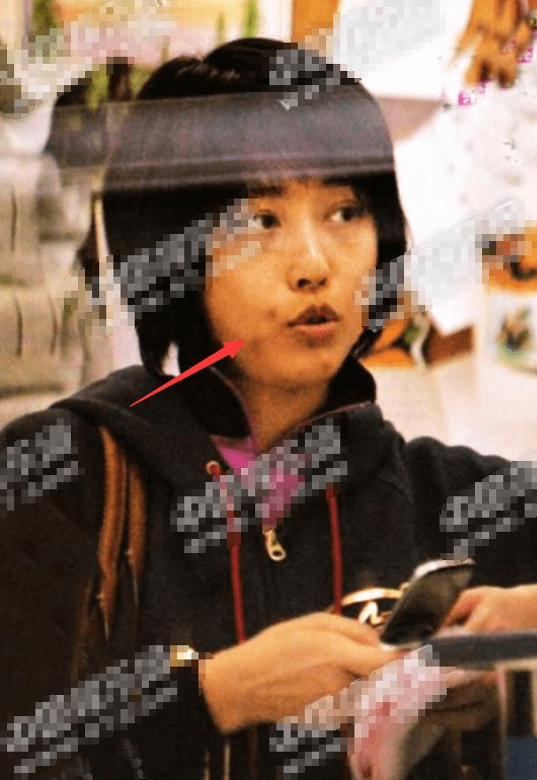 Cư dân mạng chỉ ra Châu Hải My nhiều lần lộ da mẩn đỏ như phát ban, vết sẹo và vết bầm tím trên tay. Ảnh: Sohu. Cư dân mạng chỉ ra Châu Hải My nhiều lần lộ da mẩn đỏ như phát ban, vết sẹo và vết bầm tím trên tay. Ảnh: Sohu.