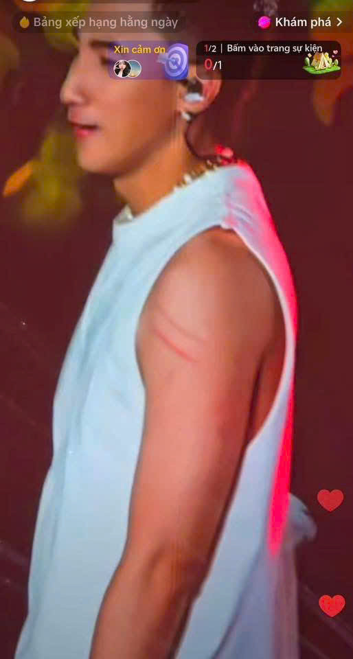 Sơn Tùng bị xước hai vệt ở tay sau tình huống quá khích của khán giả. Sơn Tùng bị xước hai vệt ở tay sau tình huống quá khích của khán giả.