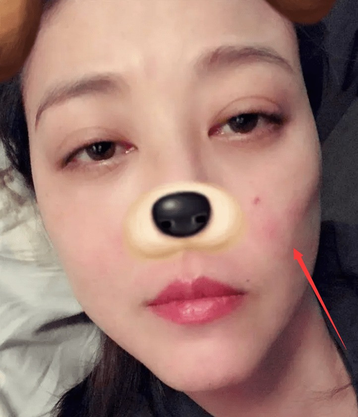 Cư dân mạng chỉ ra Châu Hải My nhiều lần lộ da mẩn đỏ như phát ban, vết sẹo và vết bầm tím trên tay. Ảnh: Sohu. Cư dân mạng chỉ ra Châu Hải My nhiều lần lộ da mẩn đỏ như phát ban, vết sẹo và vết bầm tím trên tay. Ảnh: Sohu.