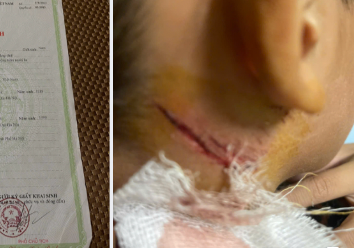 Cháu T., bị cứa cổ, hành hạ vì câu trộm cá của hàng xóm.