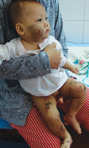 Bé Như Ý tại bệnh viện. Ảnh: C.T.V (Thanh Niên)