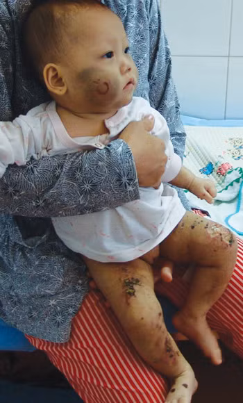 Bé Như Ý tại bệnh viện. Ảnh: C.T.V (Thanh Niên)